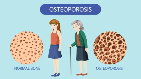 Osteoporosis 