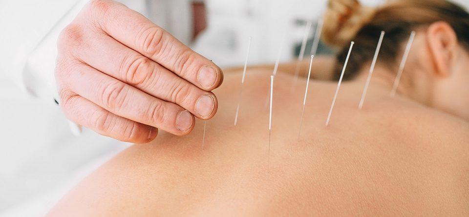 acupuncture